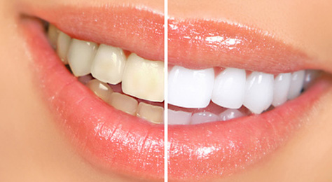 Bleaching