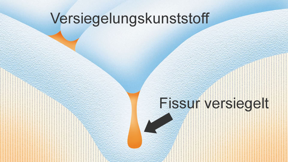 Vers3